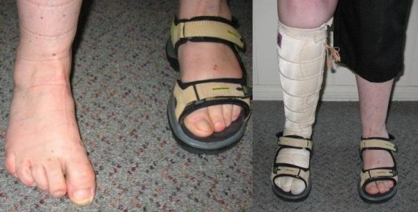 Dynamic Foot Splints - Image 4