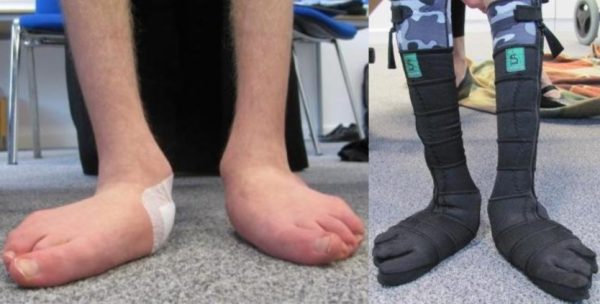 Dynamic Foot Splints - Image 3